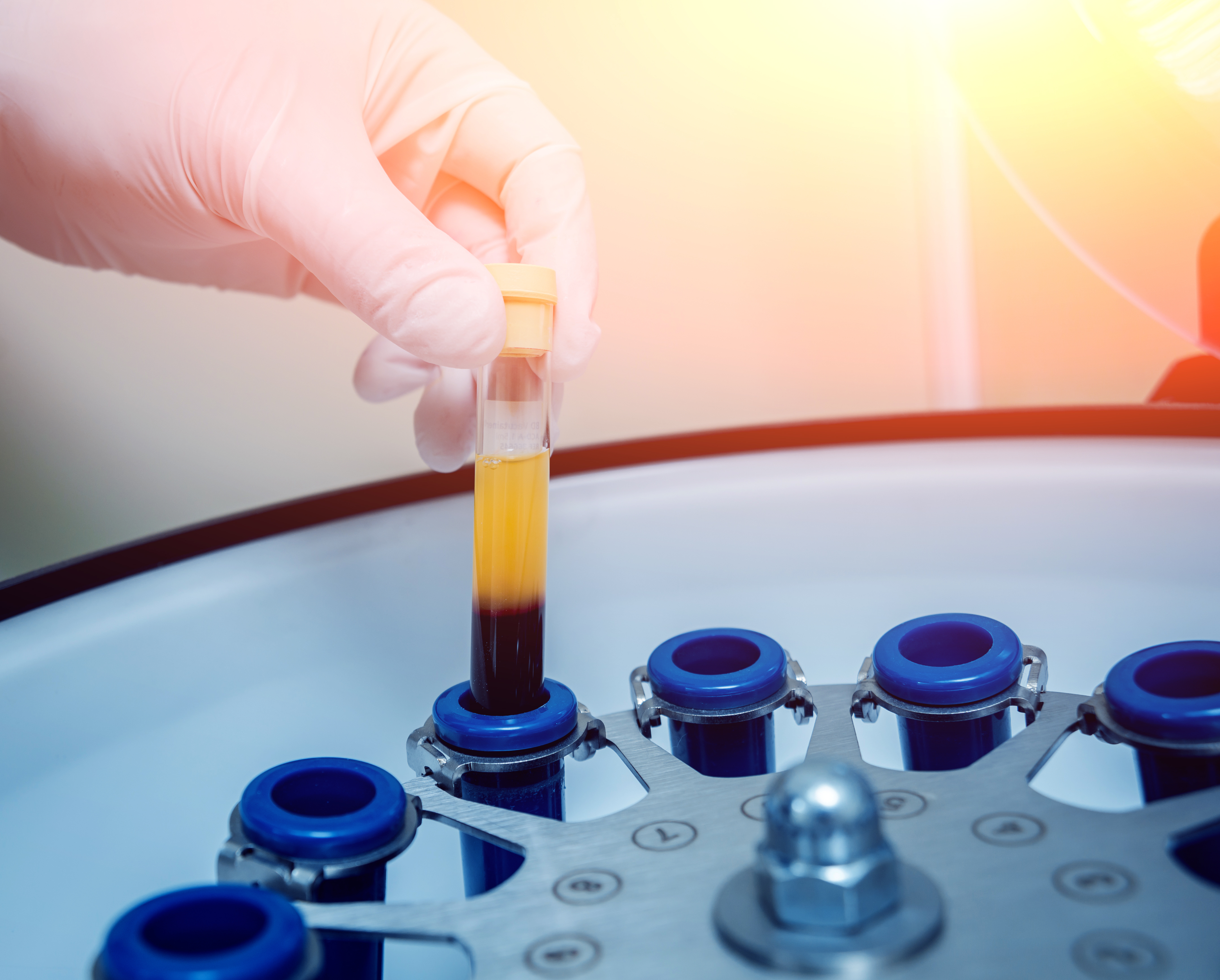 Platelet-Rich Plasma is derived from a patient's own blood, spun down to the platelets, which are useful for stimulating healing and growth