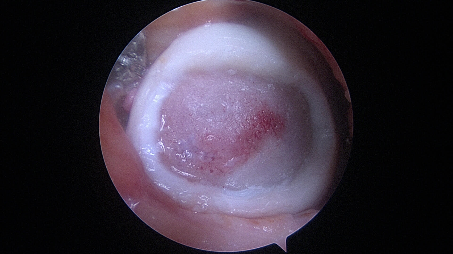 Before: A knee joint defect awaiting implantation of new cartilage cells