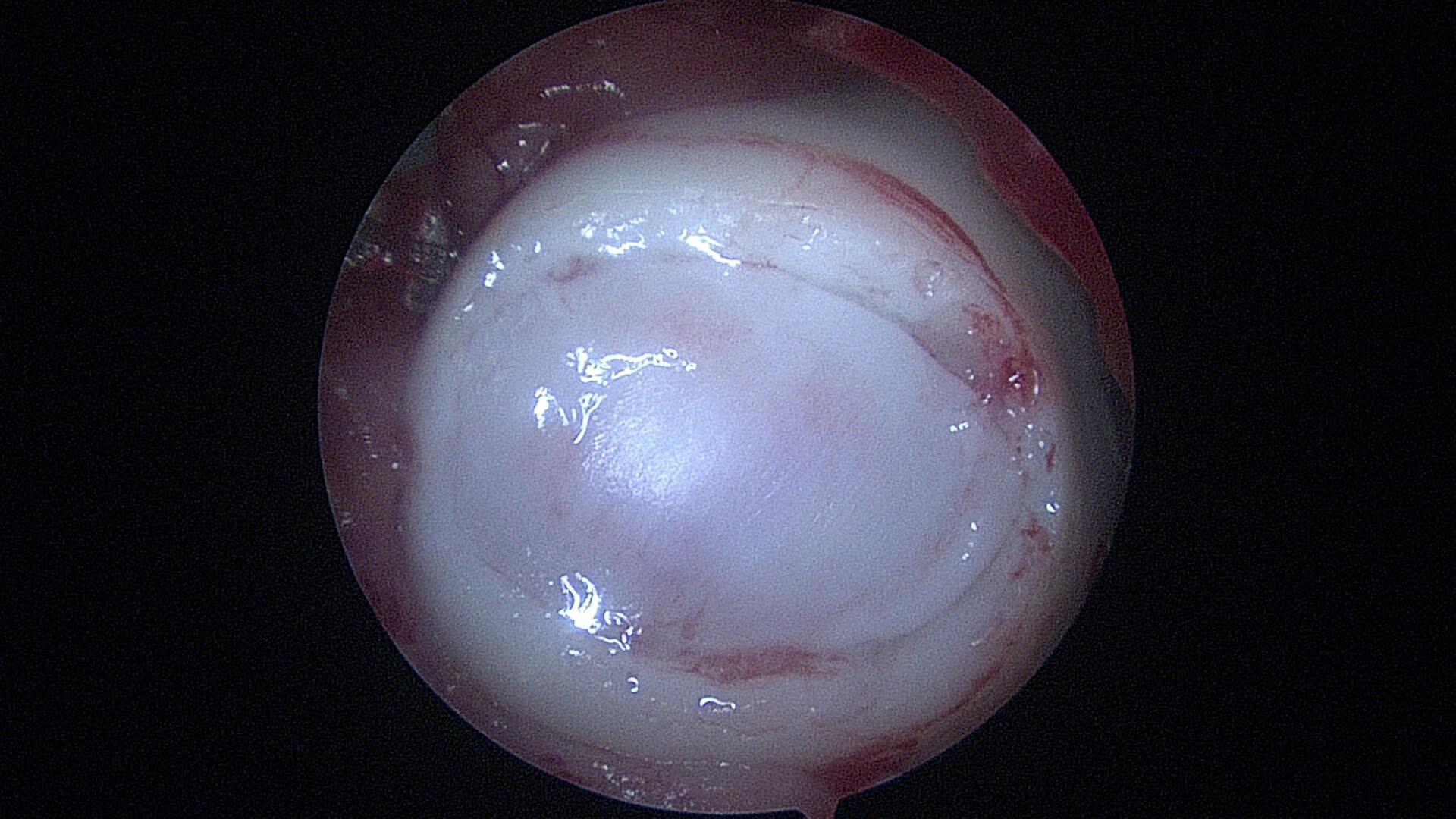 After: Completed MACI implantation for repair of the damaged cartilage