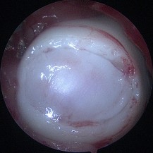 After: Completed MACI implantation for repair of the damaged cartilage